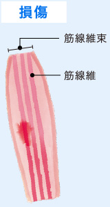 損傷 筋線維束 筋線維