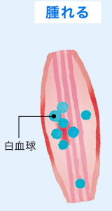 腫れる 白血球