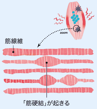 筋線維 「筋硬結」が起きる