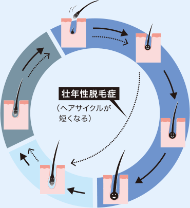 ヘアサイクル：成長期→退行期→休止期。壮年性脱毛症：ヘアサイクルが短くなること