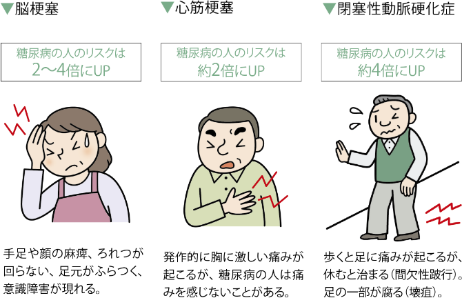 脳梗塞（糖尿病の人のリスクは2～4倍にUP）…手足や顔の麻痺、ろれつが回らない、足元がふらつく、意識障害が現れる。　心筋梗塞（糖尿病の人のリスクは約2倍にUP）…発作的に胸に激しい痛みが起こるが、糖尿病の人は痛みを感じないことがある。　閉塞性動脈硬化症（糖尿病の人のリスクは約4倍にUP）…歩くと足に痛みが起こるが、休むと治まる（間欠性跛行）。足の一部が腐る（壊疽）。