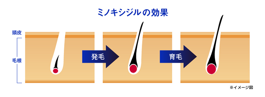 ミノキシジルの効果 発毛→育毛 ※イメージ図