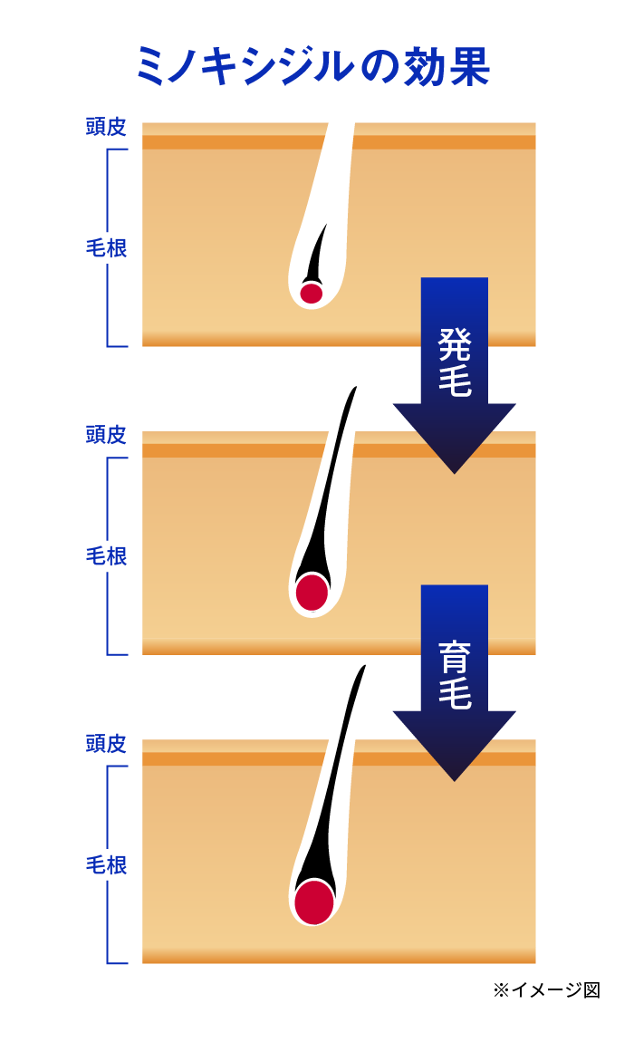 ミノキシジルの効果 発毛→育毛 ※イメージ図