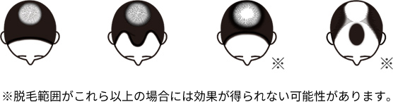 ※ 脱毛範囲がこれら以上の場合には効果が得られない可能性があります。