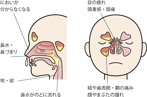 長引く鼻水 鼻づまり 副鼻腔炎 公式 大正製薬ダイレクトオンラインショップ