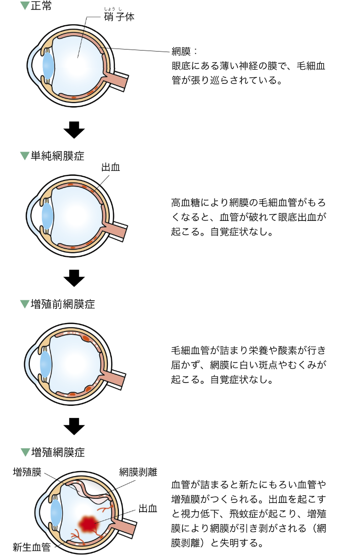正常…眼底にある薄い神経の膜で、毛細血管が張り巡らされている。　単純網膜症…高血糖により網膜の毛細血管がもろくなると、血管が破れて眼底出血が起こる。自覚症状なし。　増殖前網膜症…毛細血管が詰まり栄養や酸素が行き届かず、網膜に白い斑点やむくみが起こる。自覚症状なし。　増殖網膜症…血管が詰まると新たにもろい血管や増殖膜がつくられる。出血を起こすと視力低下、飛蚊症が起こり、増殖膜により網膜が引きはがされる（網膜剥離）と失明する。