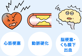 心筋梗塞、動脈硬化、脳梗塞・くも膜下出血